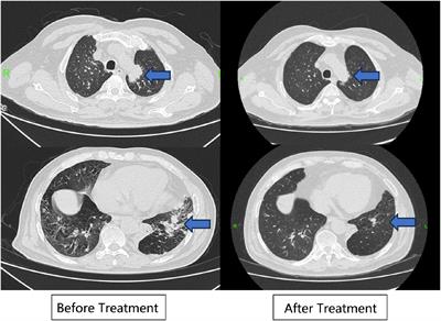 Combination treatment with telitacicept, cyclophosphamide and glucocorticoids for severe Granulomatous polyangiitis: a case report and literature review